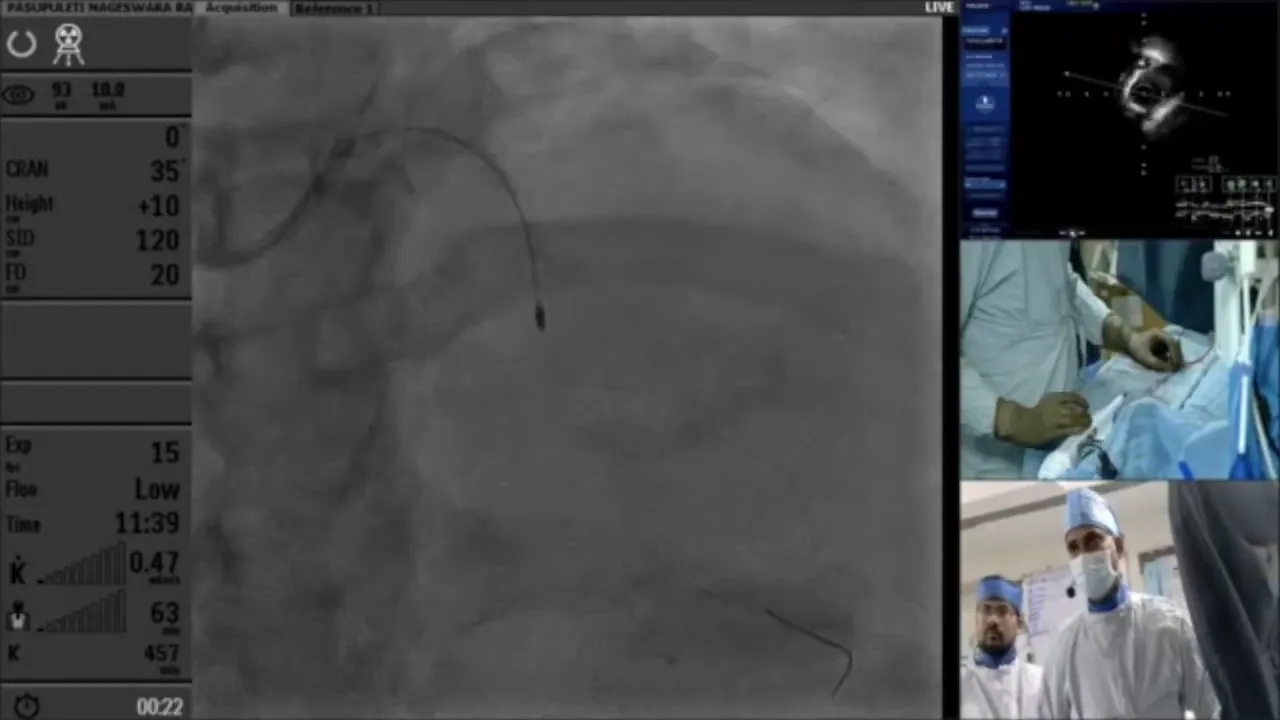 Post-rotablation IVUS assessment