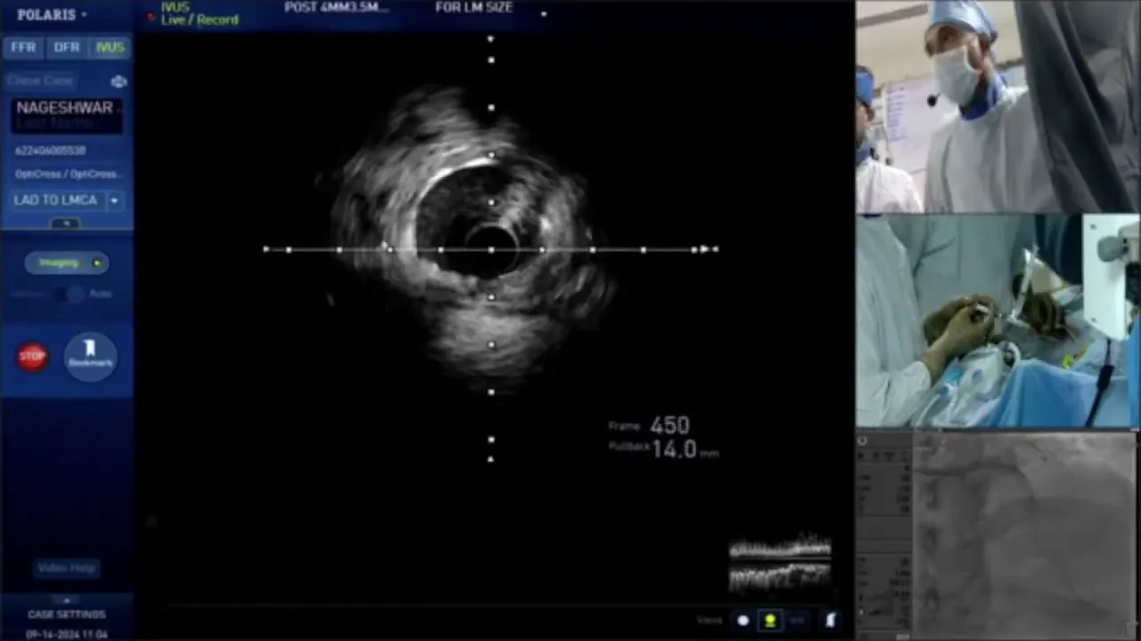 Post-procedure IVUS imaging