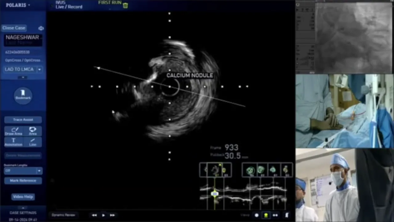 IVUS imaging showing calcium nodules