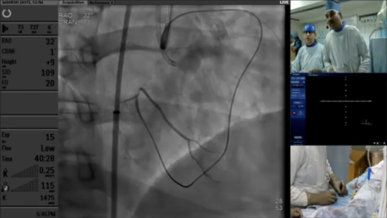 Wire selection discussion during CTO procedure