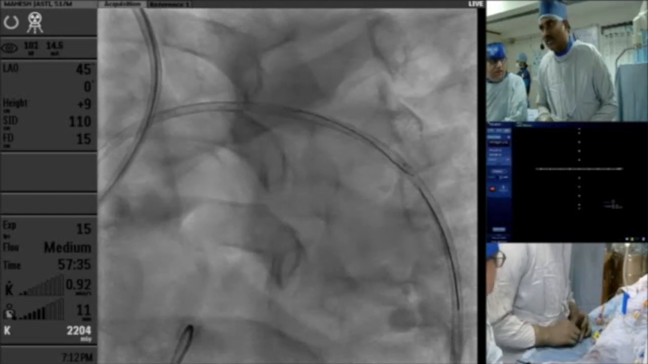 Balloon angioplasty technique in action