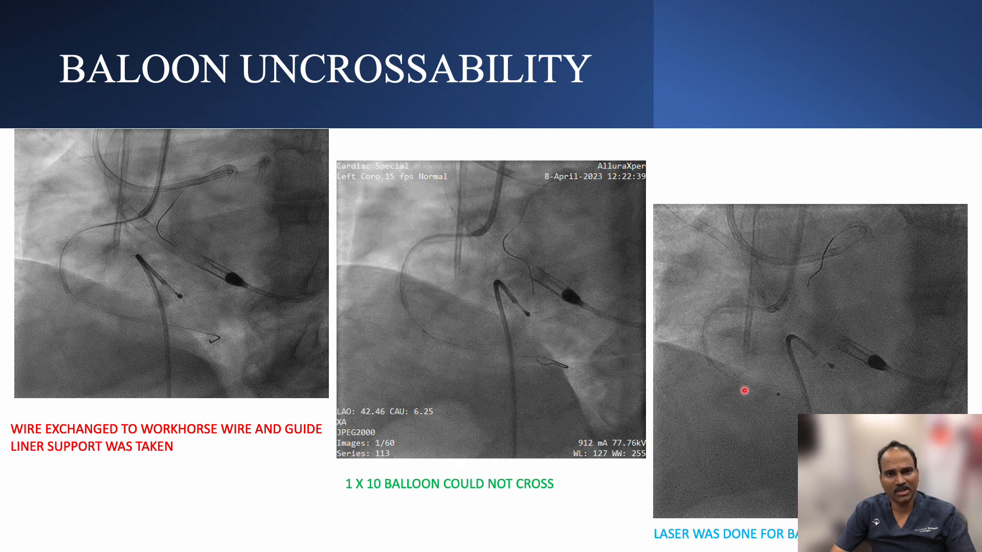 Laser atherectomy for balloon uncrossability