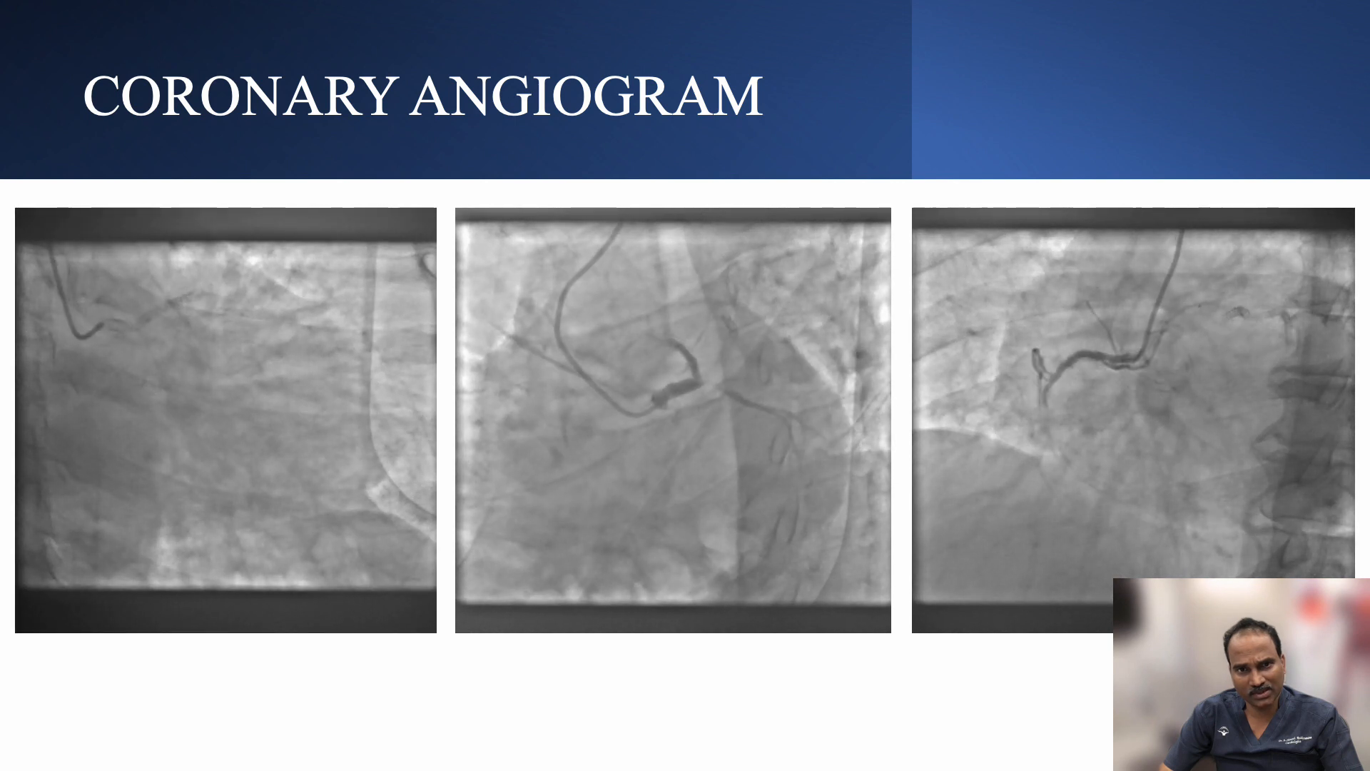 Coronary angiogram showing RCA total occlusion