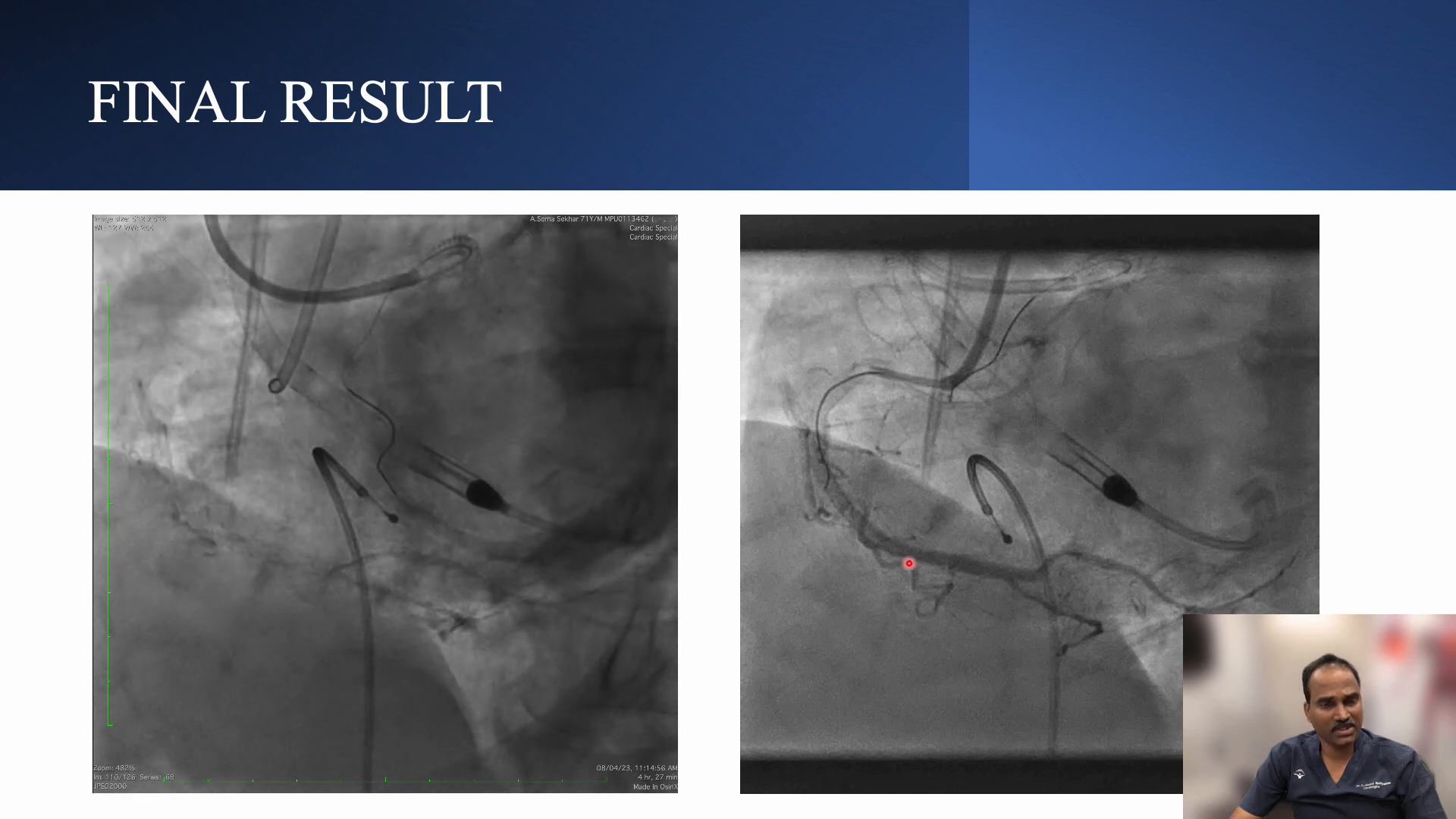 Final angiographic result after Mini Crush technique