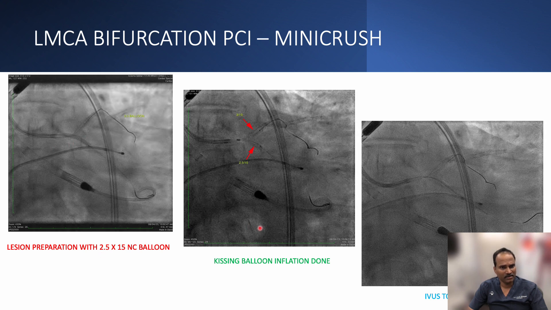 Mini Crush technique for LMCA bifurcation