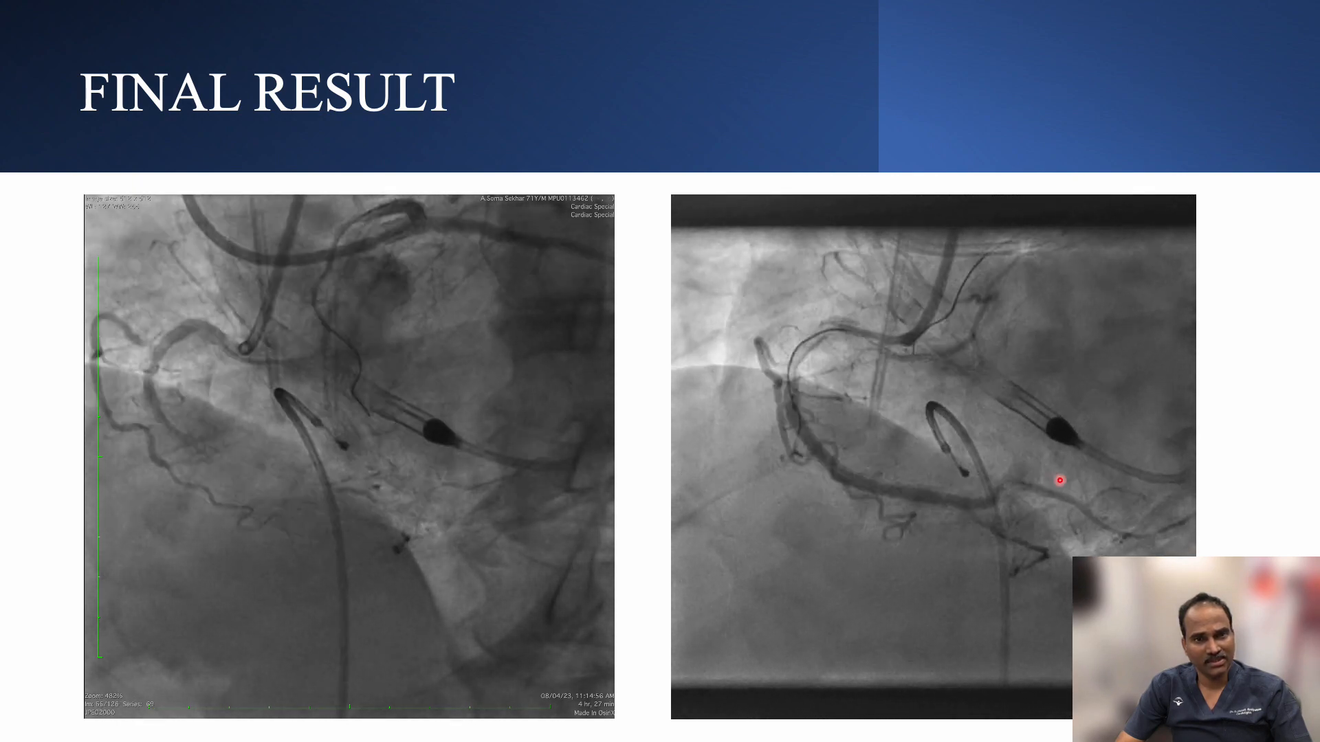 Final angiographic result after PCI