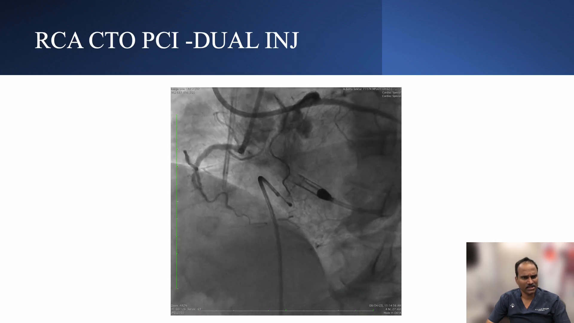 Dual injection strategy for RCA CTO