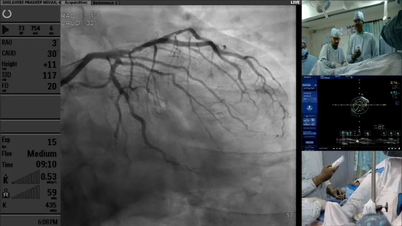 Proximal lesion and significant calcification