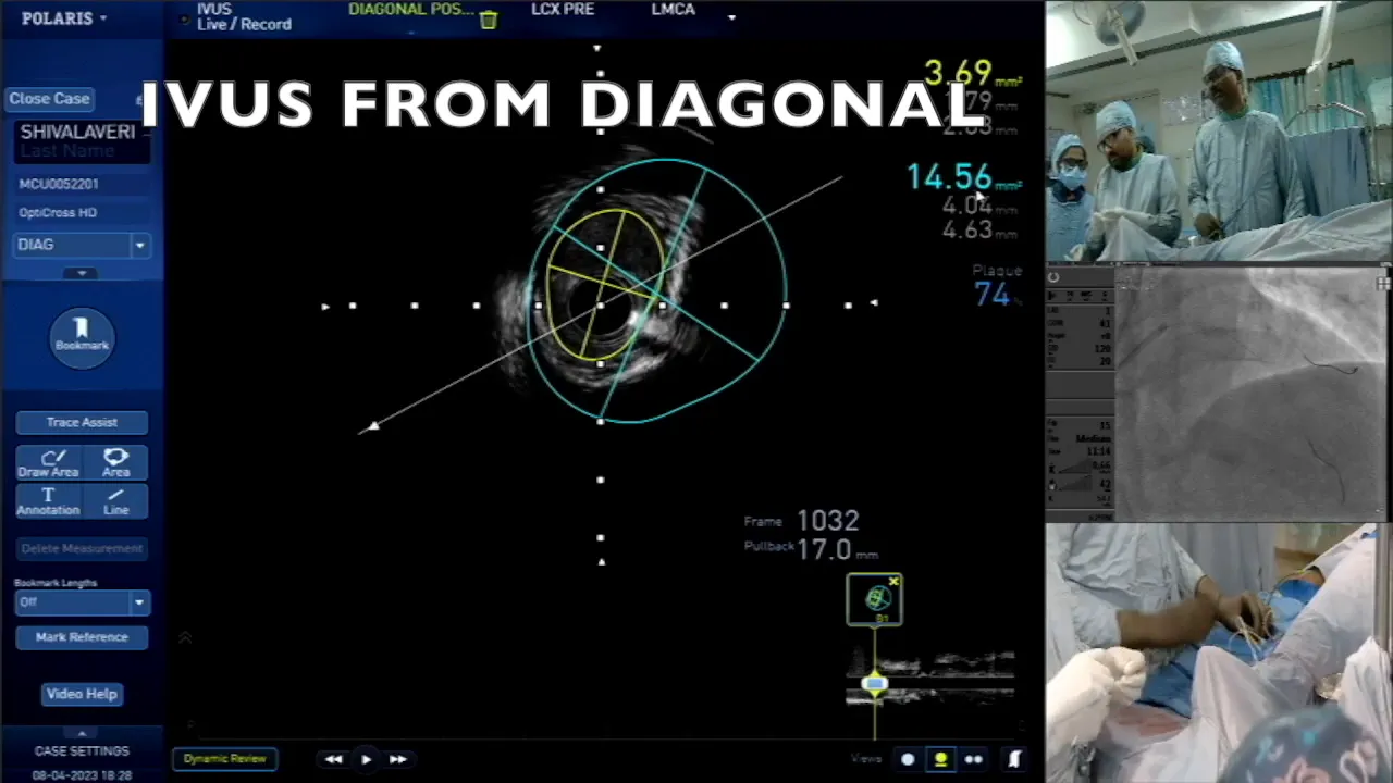 Assessing the ostial diagonal artery