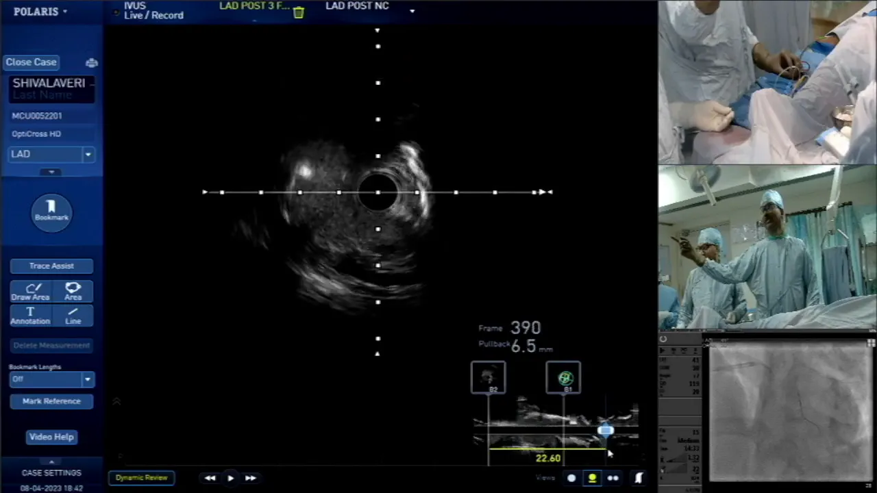 Preparing to place the distal stent