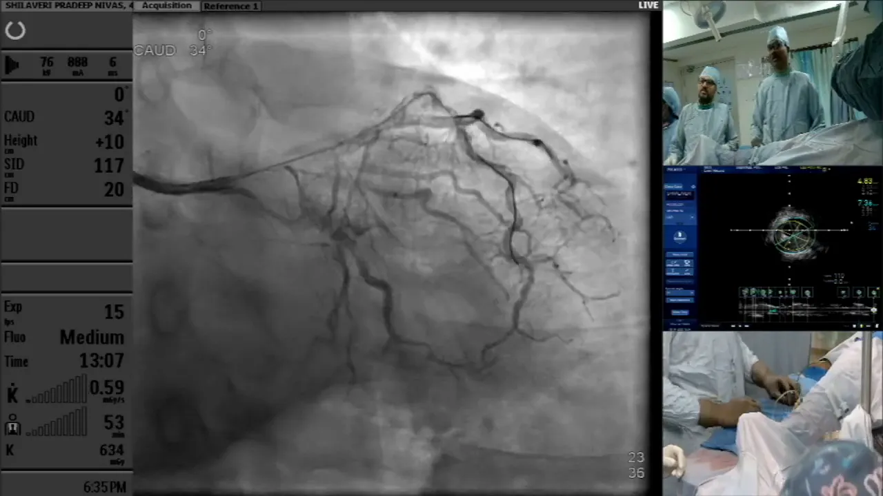 Decision-making regarding diagonal lesion stenting