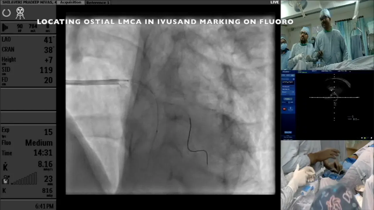 Placing the proximal stent first