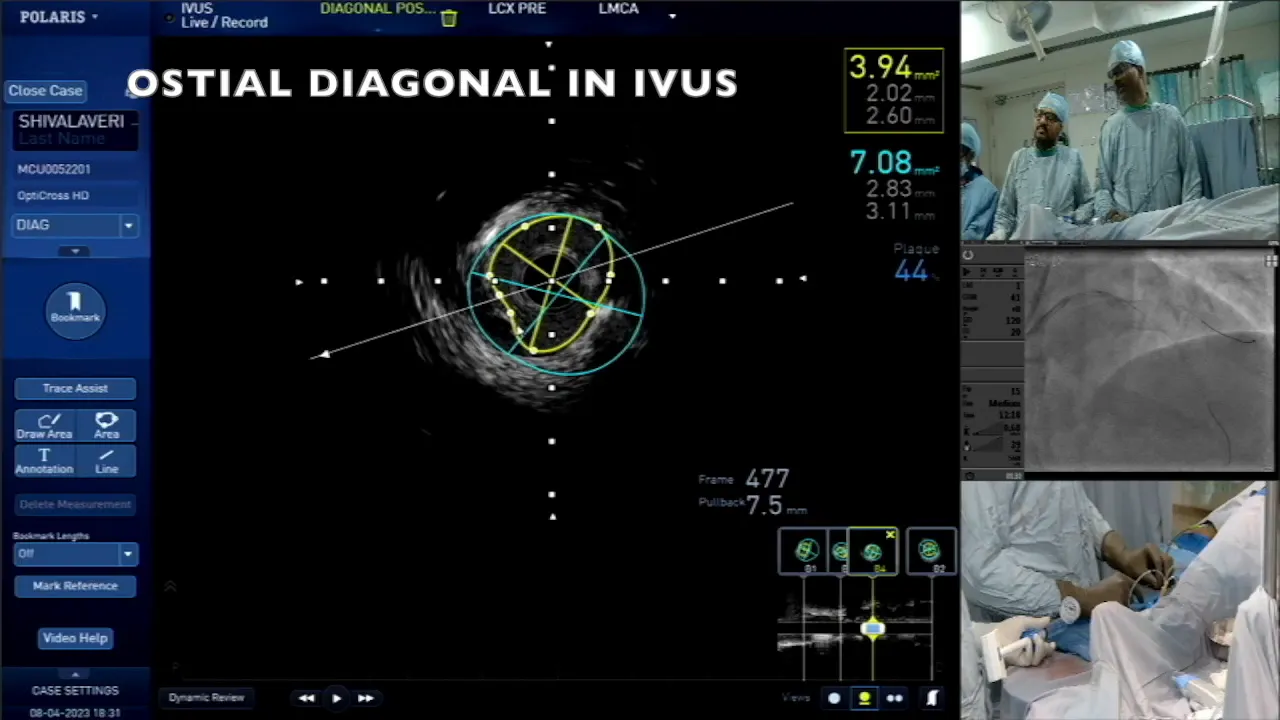 Evaluating the diagonal lesion