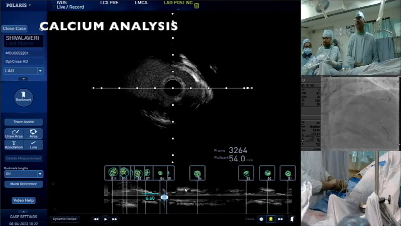 Calcium scoring and length assessment