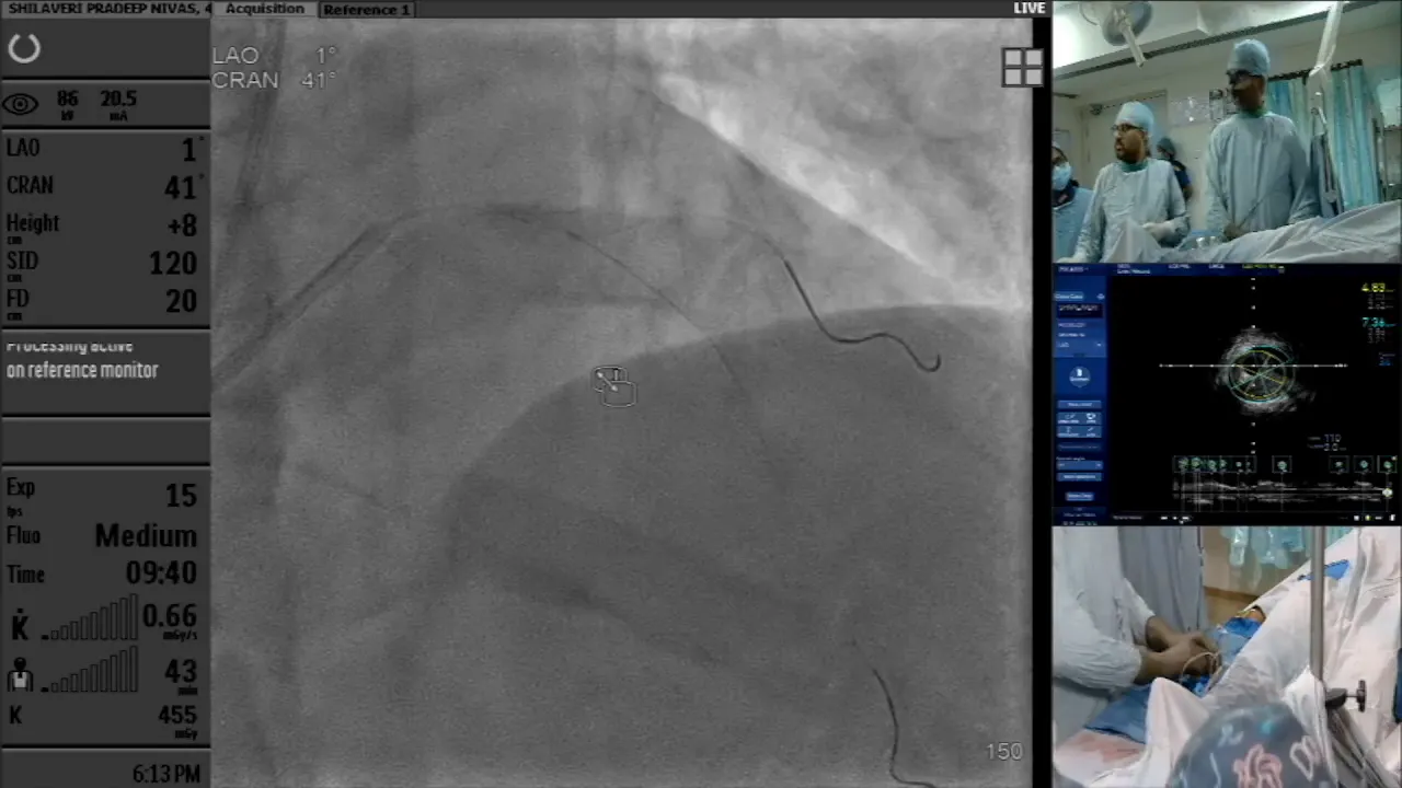 IVUS analysis of LCX