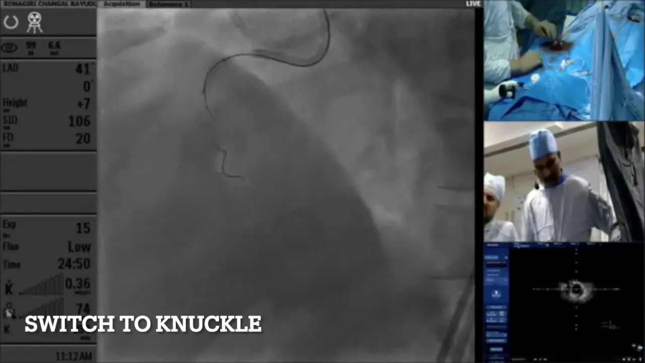 Microcatheter trapped by balloon to support knuckle wire advancement