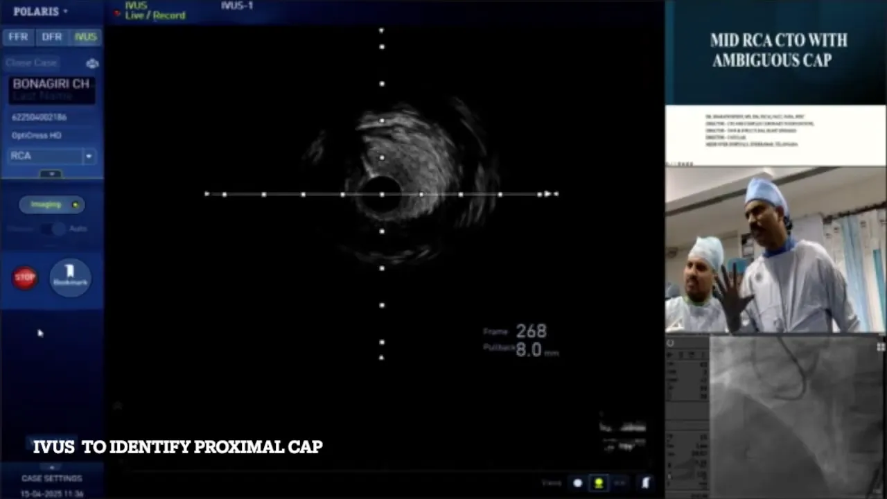 IVUS imaging showing size jump and ambiguous proximal cap at 12:00