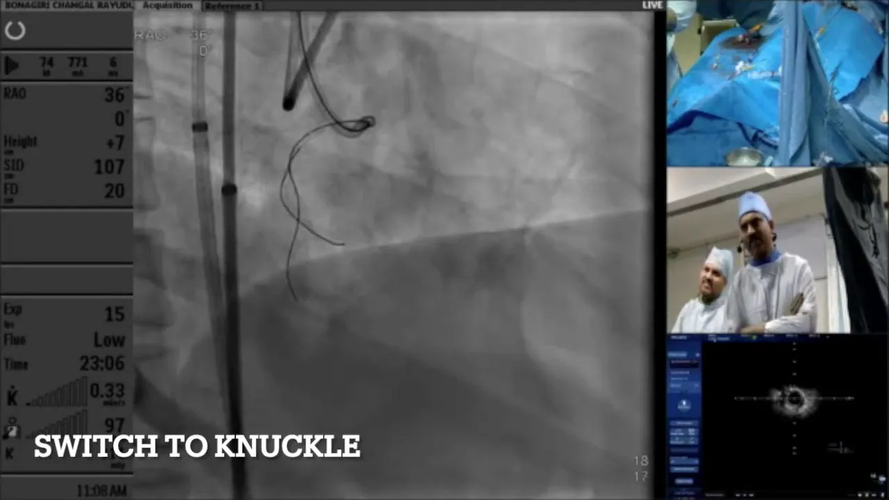 Balloon inflation to facilitate knuckle wire advancement