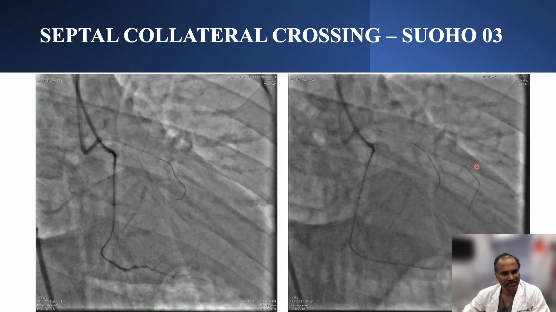 Retrograde access through septal collateral