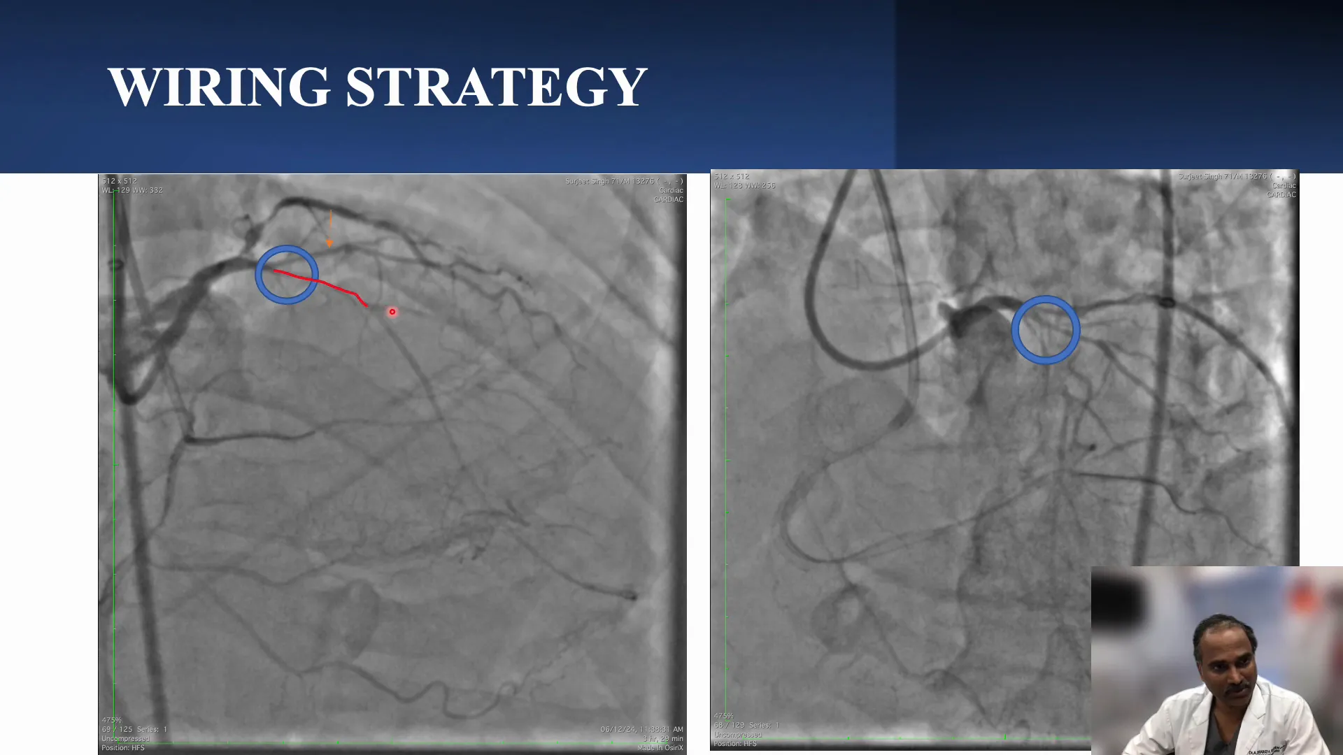 IVUS-guided cap puncture strategy