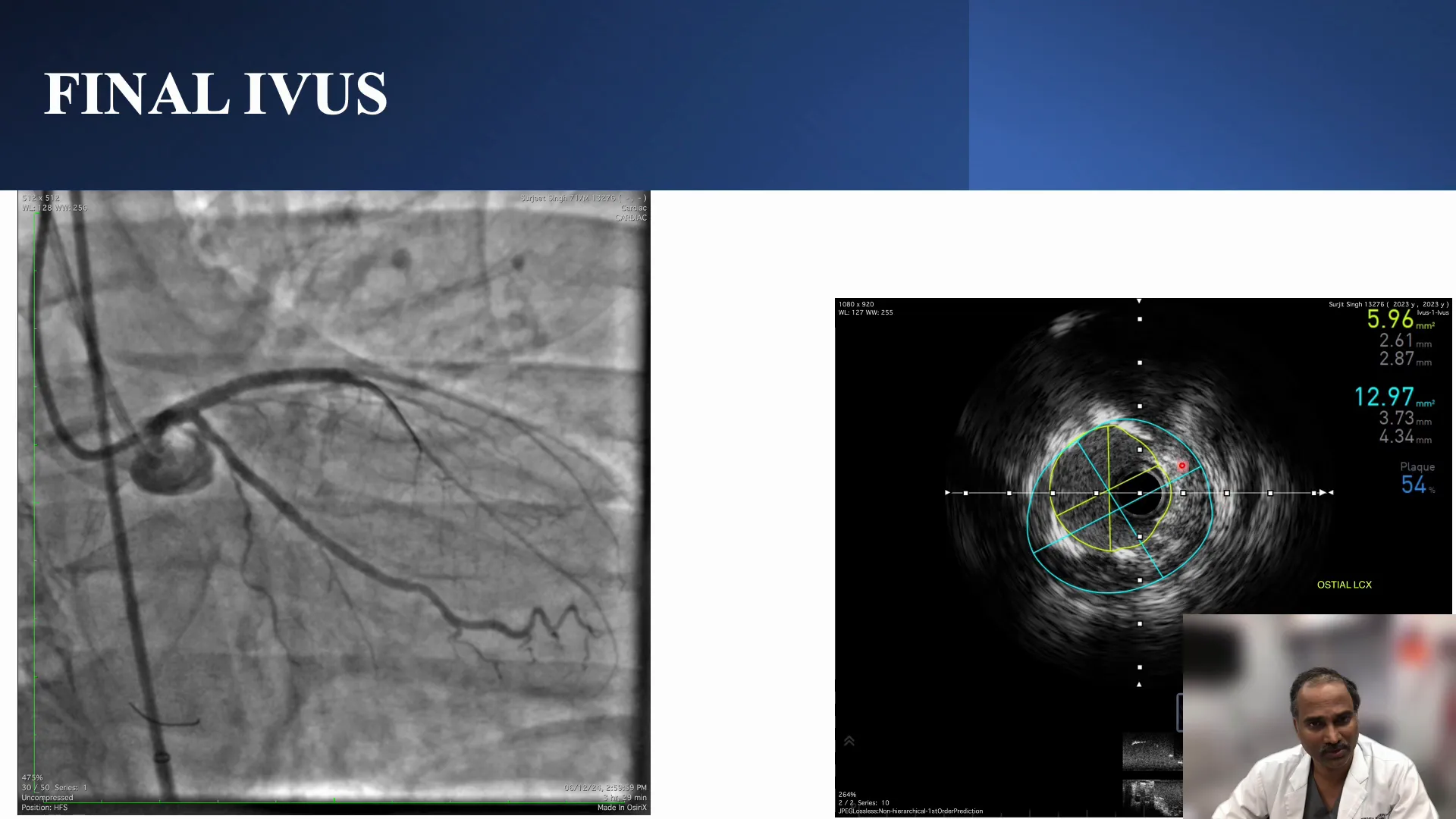 Final angiographic results showing vessel patency