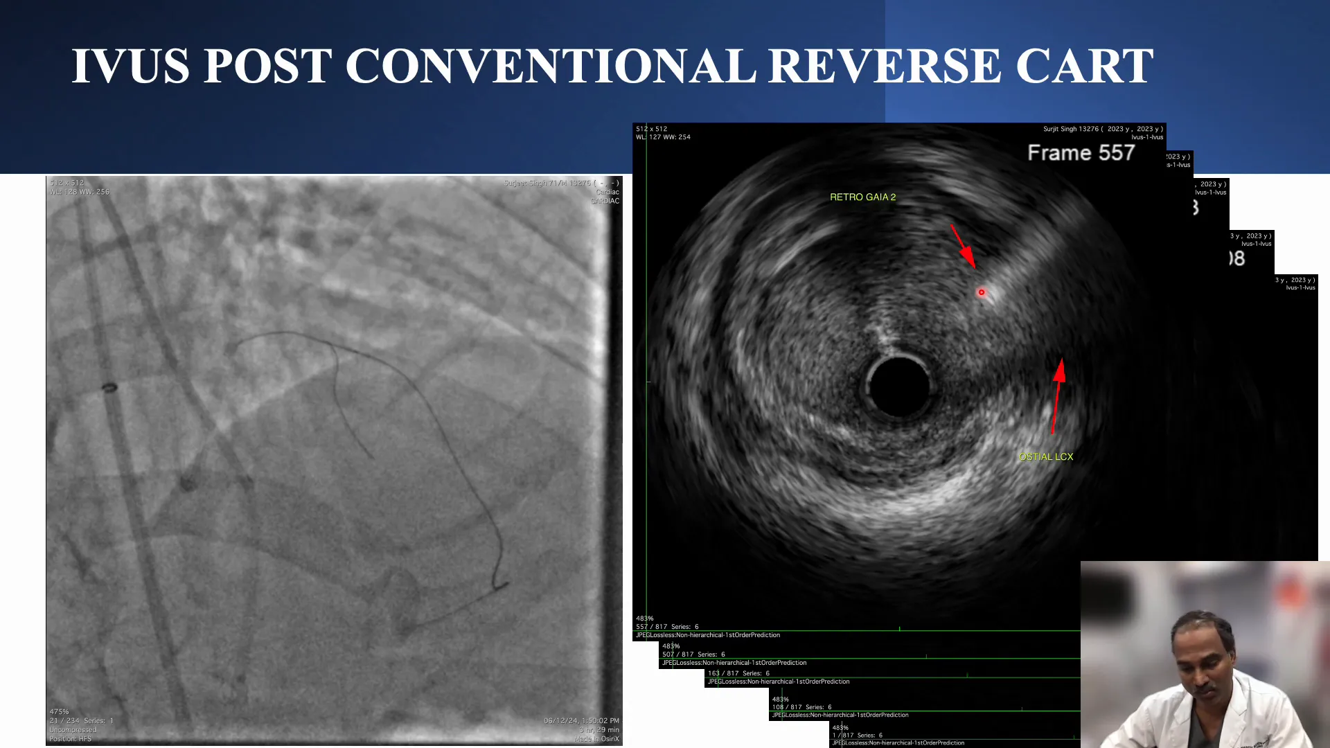 IVUS confirmation of wire location