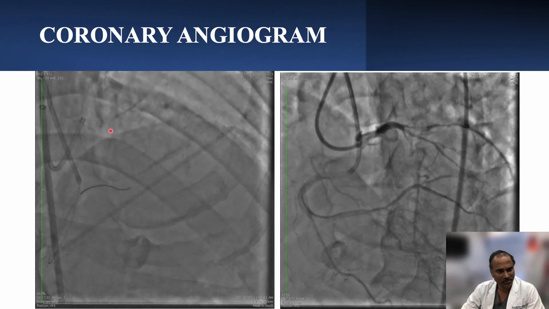 Dual angiography showing mid-LAD CTO and branches