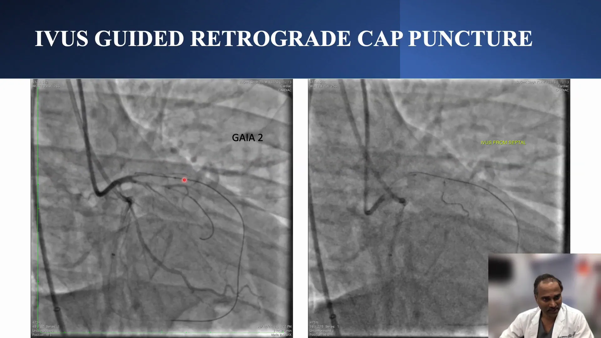 Confirmation of clear distal cap