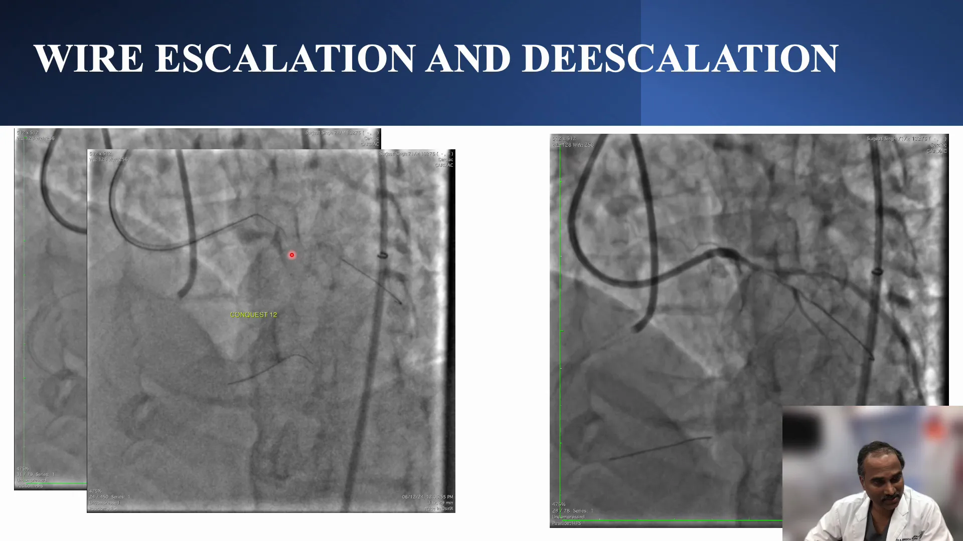 Contrast extravasation indicating potential perforation