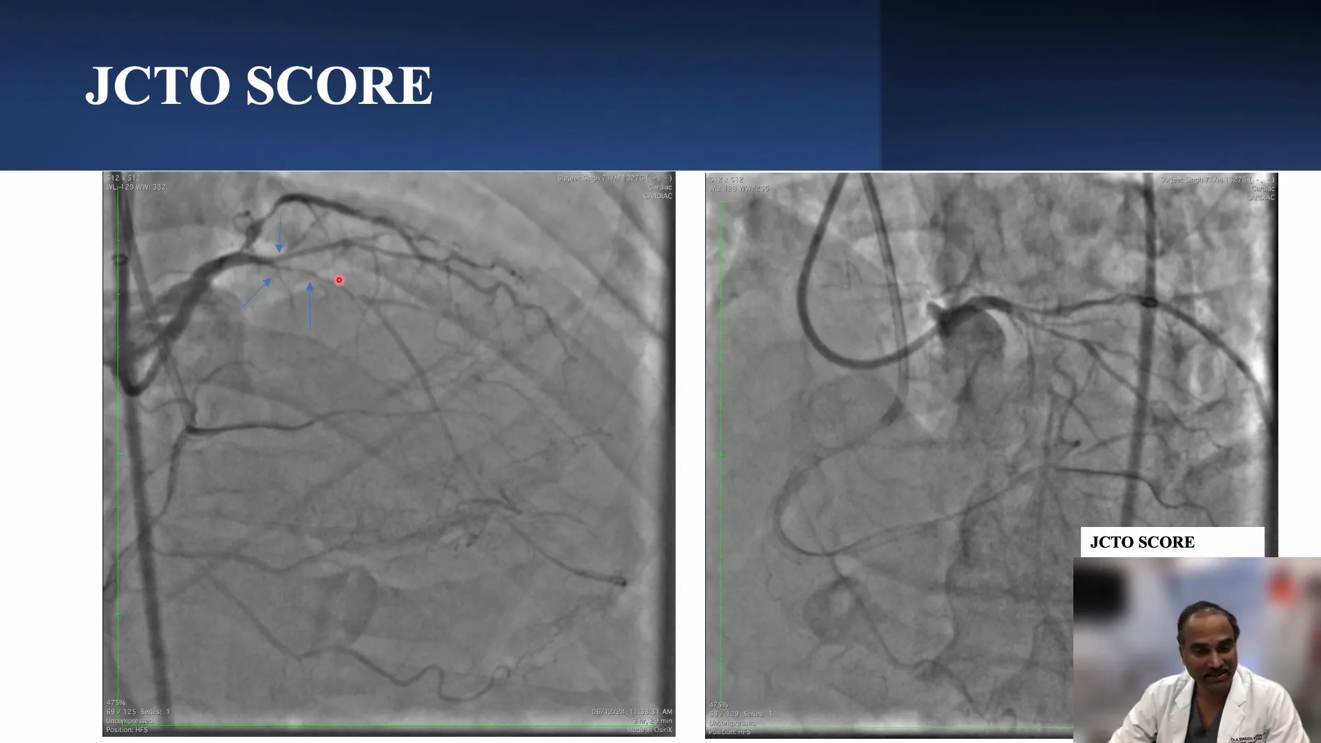 Ambiguous proximal cap with multiple branches