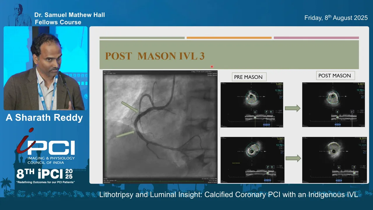 Post-IVL IVUS demonstrating improved stent expansion and more circular cross-sectional area