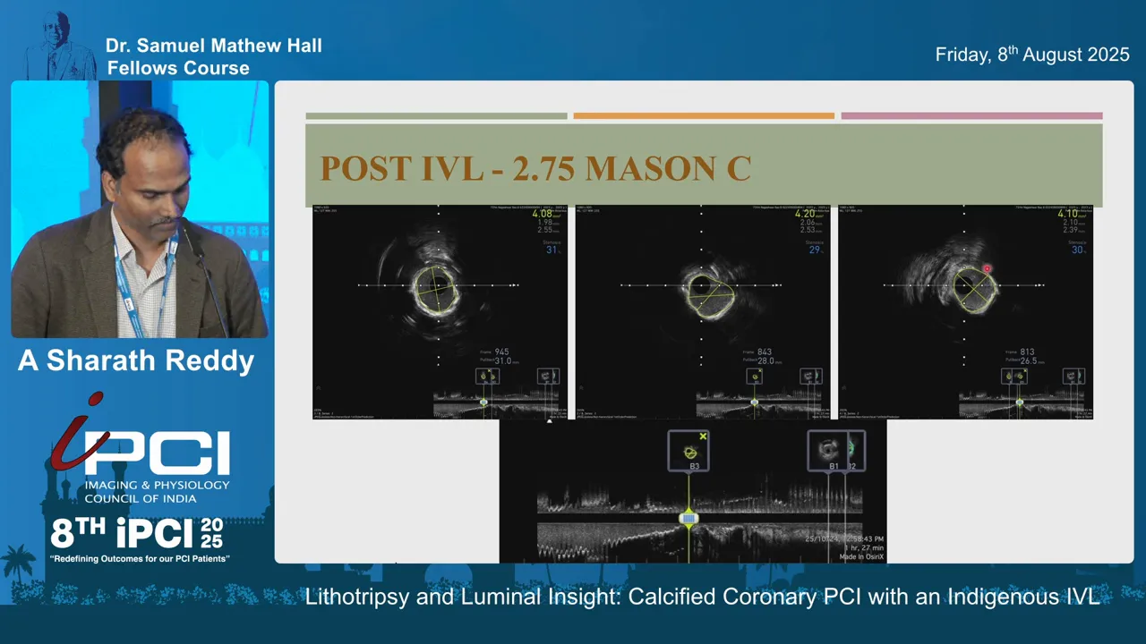 Post-IVL intravascular ultrasound showing calcium fractures and improved luminal area