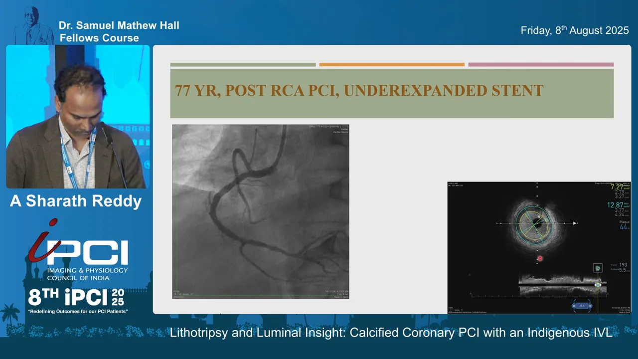 IVUS showing underexpanded stent with eccentric, oval cross-section prior to IVL