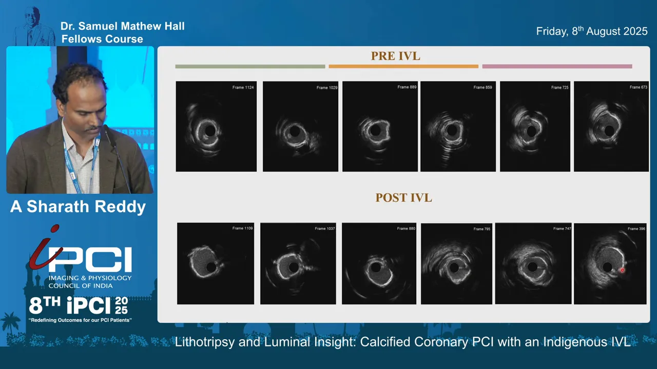 IVUS frame showing clear fractures in calcium after IVL