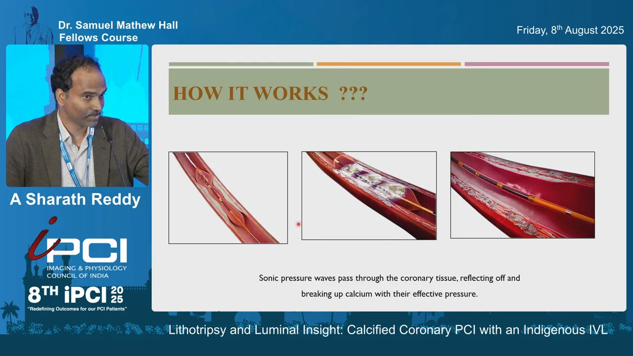 Schematic depiction of sonic pressure waves producing microfractures in calcified plaque