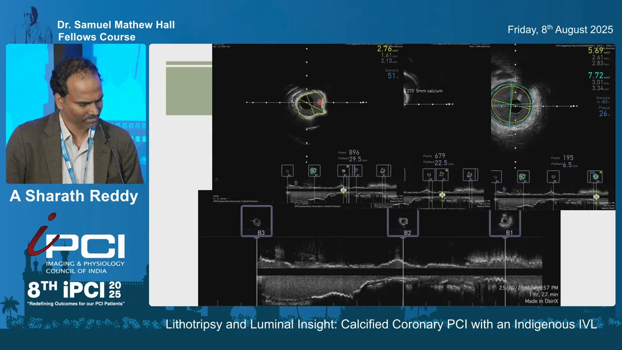 Intravascular image showing 360-degree calcified plaque in proximal LAD pre-intervention