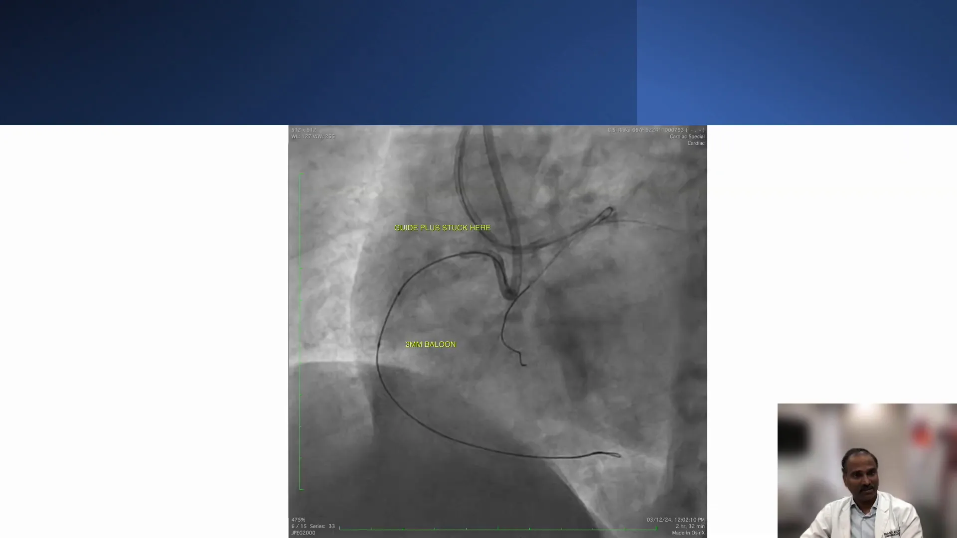 Challenges in Anomalous Right Coronary Artery Cases