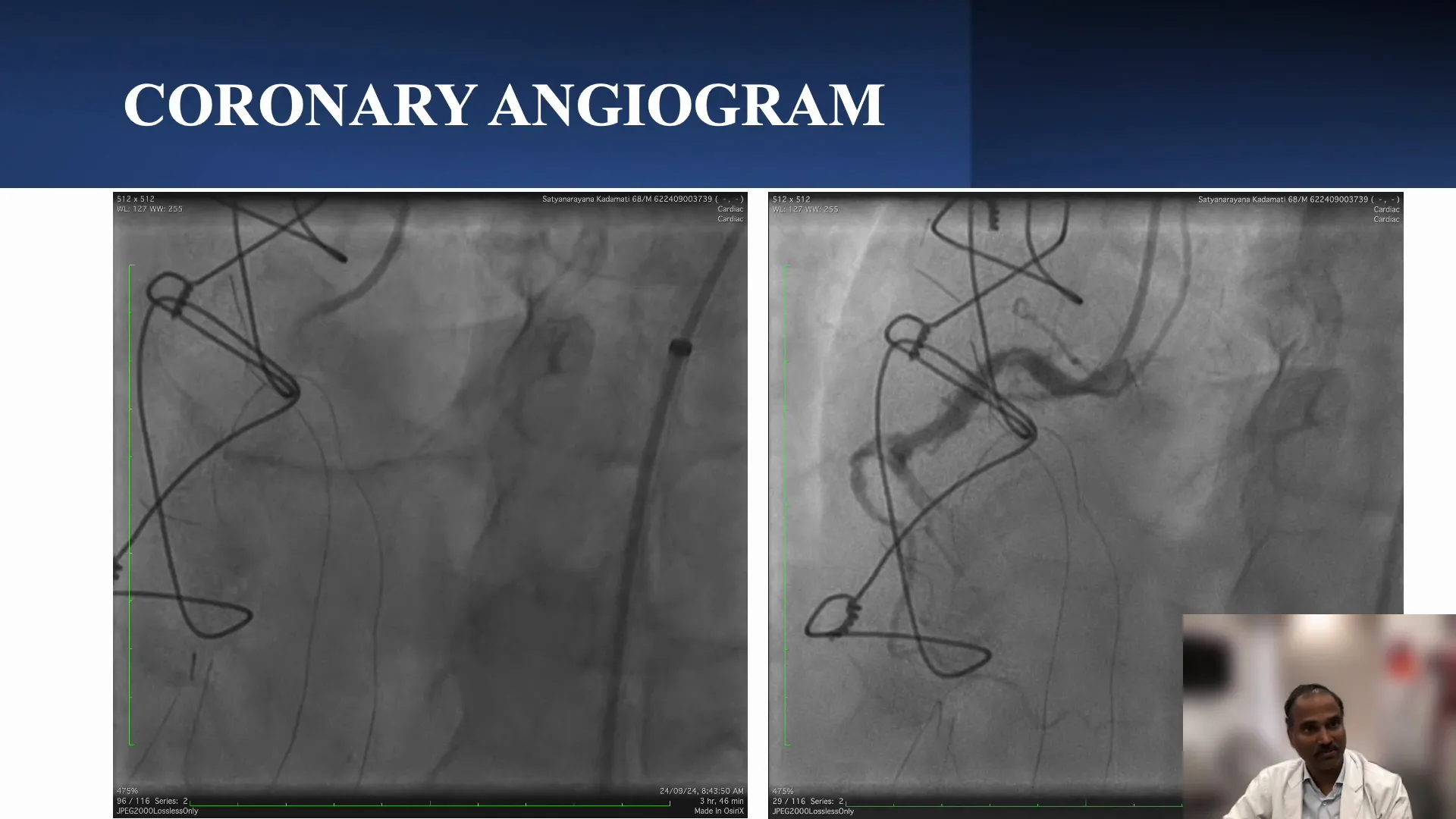 Anatomy of the Right Coronary Artery