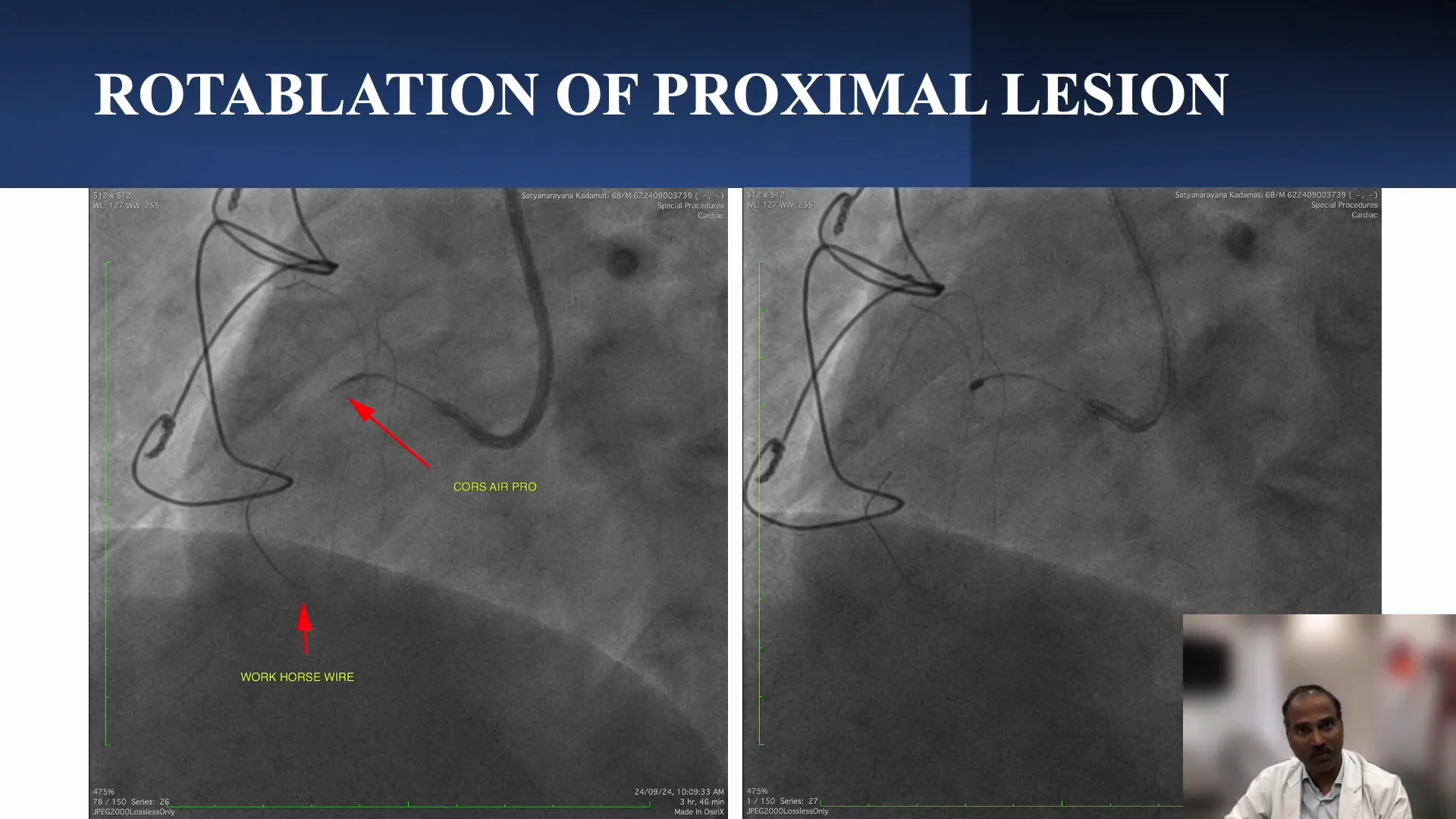 Sequential Ablation Process Explained