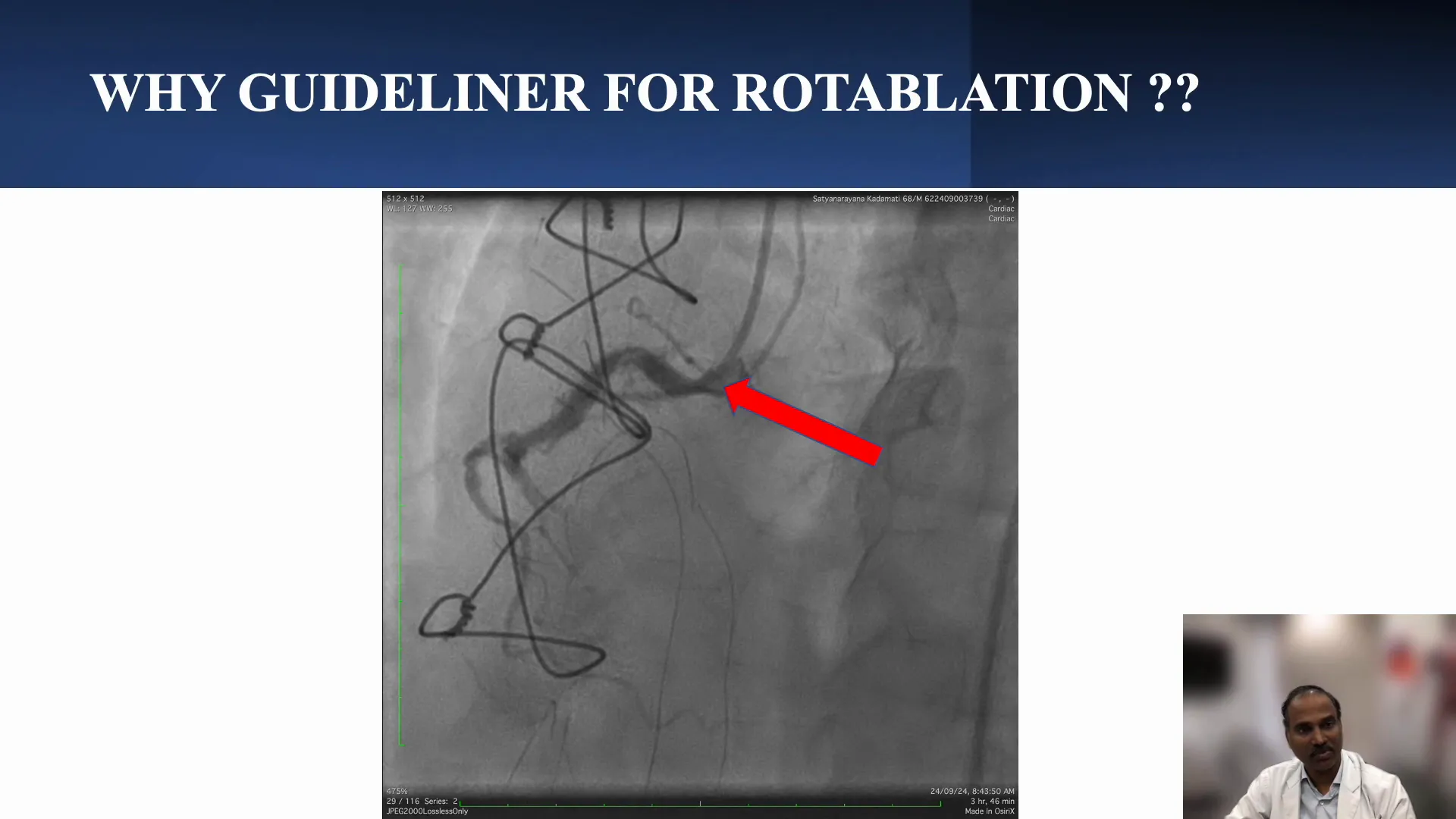 Role of Guide Extension in Rotablation