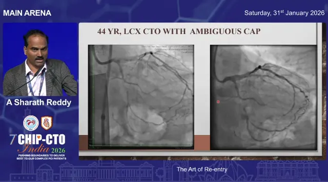 Presentation slide titled '44 YR, LCX CTO WITH AMBIGUOUS CAP' displaying two angiographic panels side‑by‑side that show the occluded LCx and distal vessel morphology, with the presenter at left.