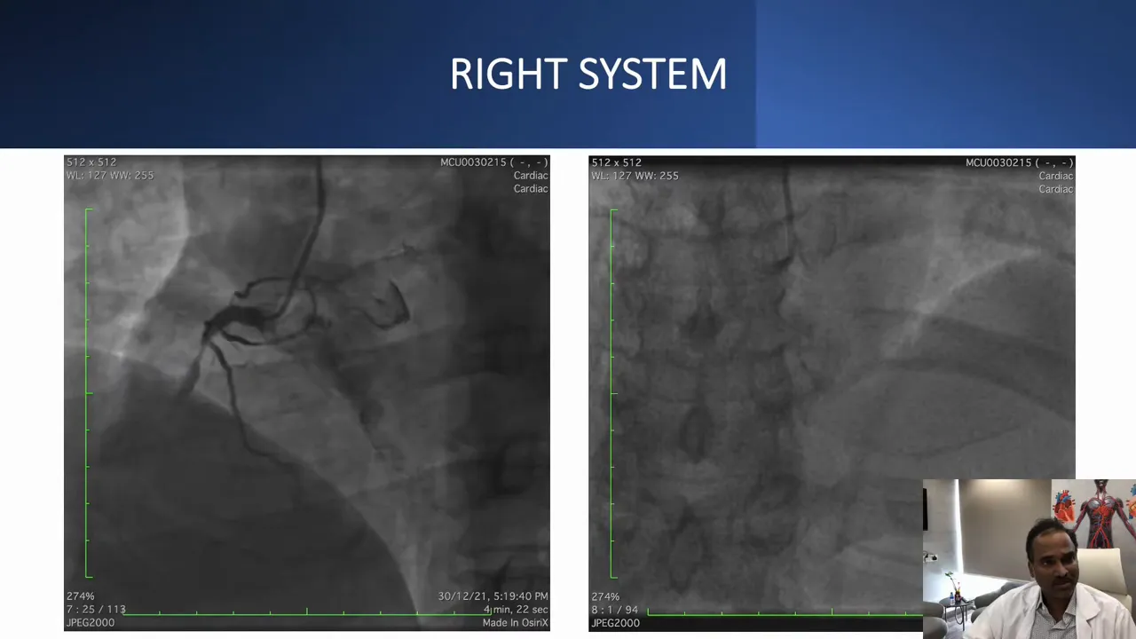 Dual-panel angiographic image showing opacified right coronary artery (RCA) with contrast demonstrating a short chronic total occlusion appearance.