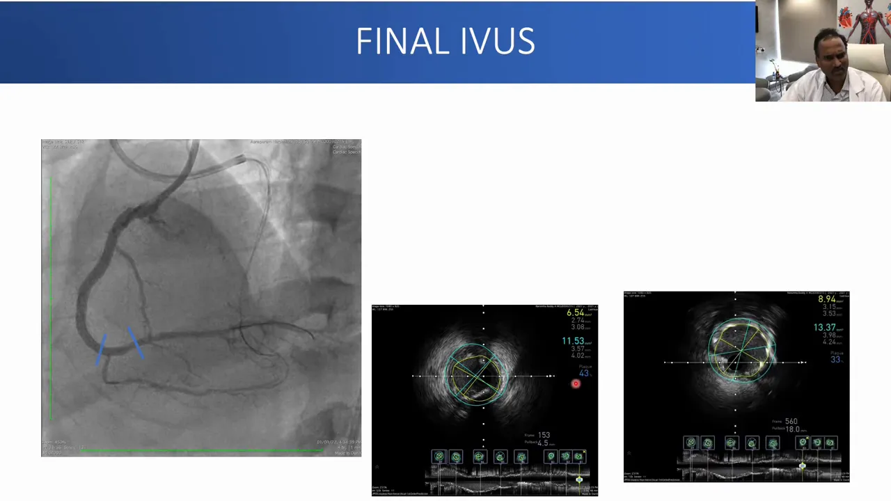 Composite 'FINAL IVUS' slide showing a right coronary artery angiogram (left) and two IVUS cross‑section images (center and right) with lumen measurements indicating stent expansion and branch preservation.