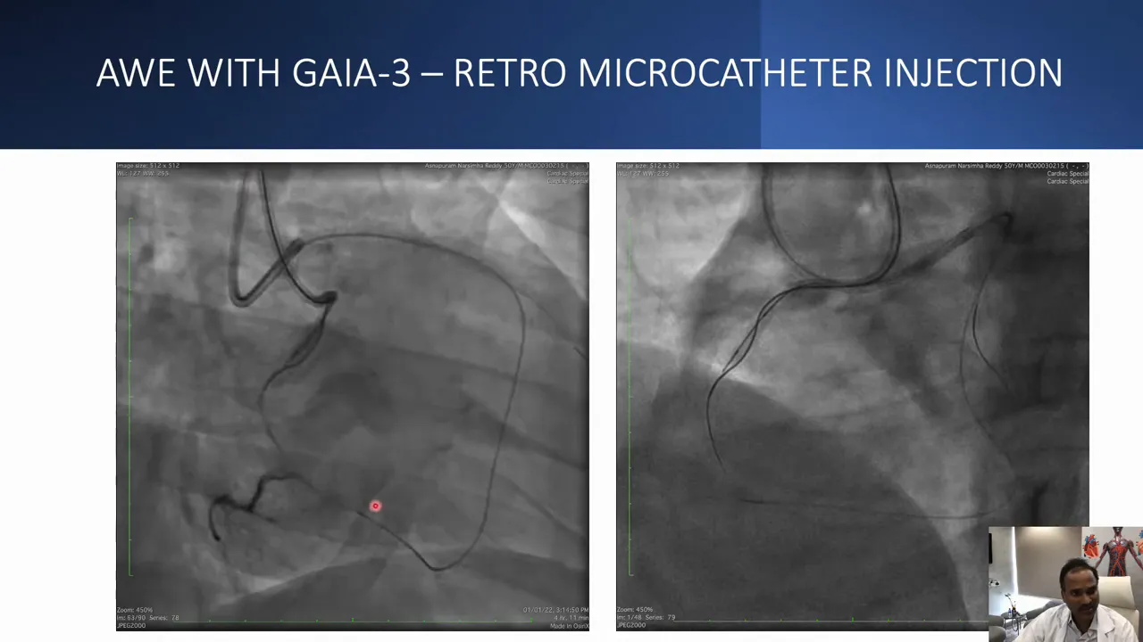 Dual-panel orthogonal angiogram with clear opacification of the distal RCA and visible retrograde and antegrade wires; presenter inset visible in corner.