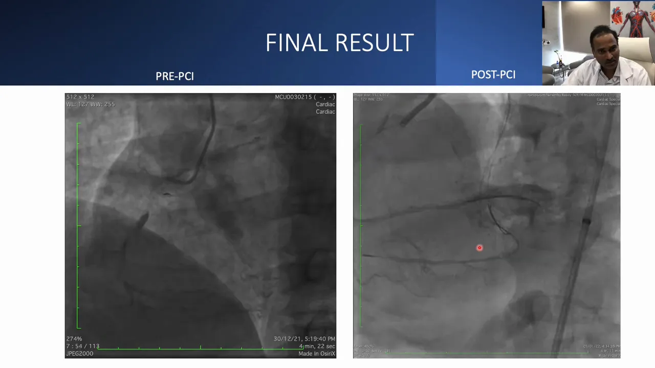 Dual-panel 'FINAL RESULT' angiogram with a clear post-PCI right-panel showing distal RCA and preserved posterior descending artery (PDA) flow.