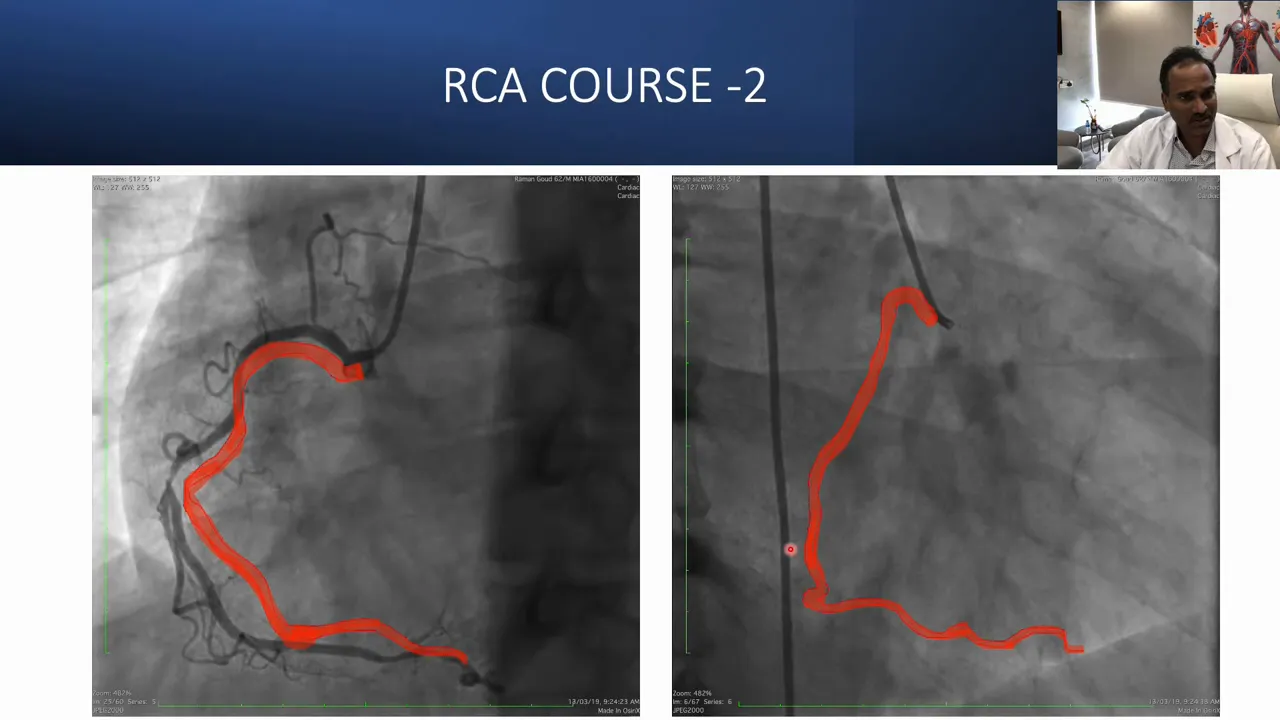 Dual-panel angiographic image titled 'RCA COURSE -2' with a red overlay tracing the right coronary artery in two projections and a presenter inset.