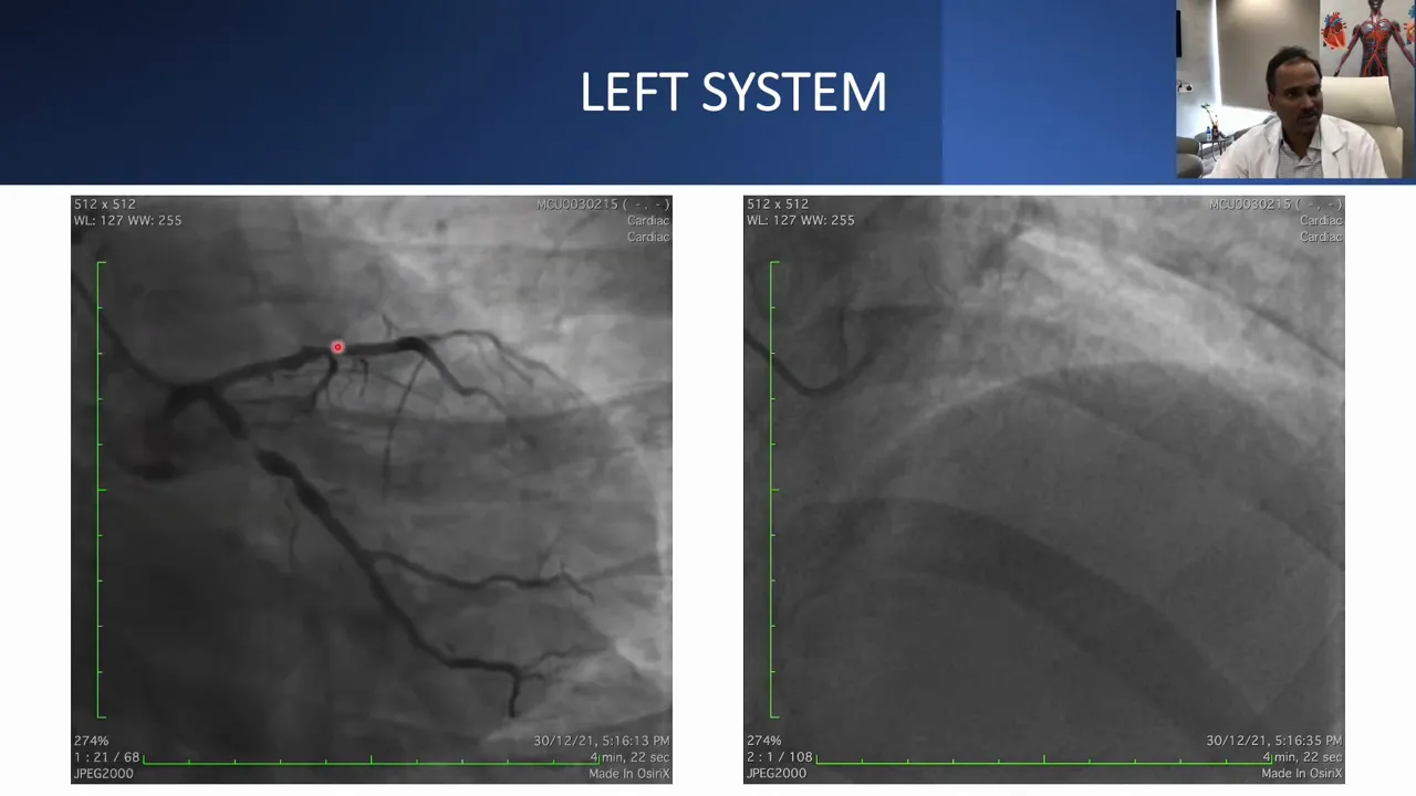 High-contrast angiographic image of the left coronary system showing LAD and LCX branches with visible lesions