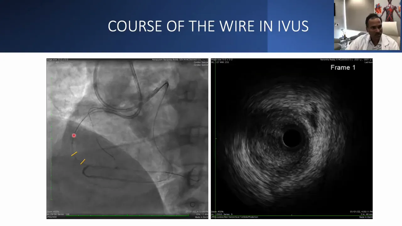 Split-panel image: left panel angiographic overlay showing wire course, right panel IVUS cross-sectional image demonstrating the wire within the true lumen.