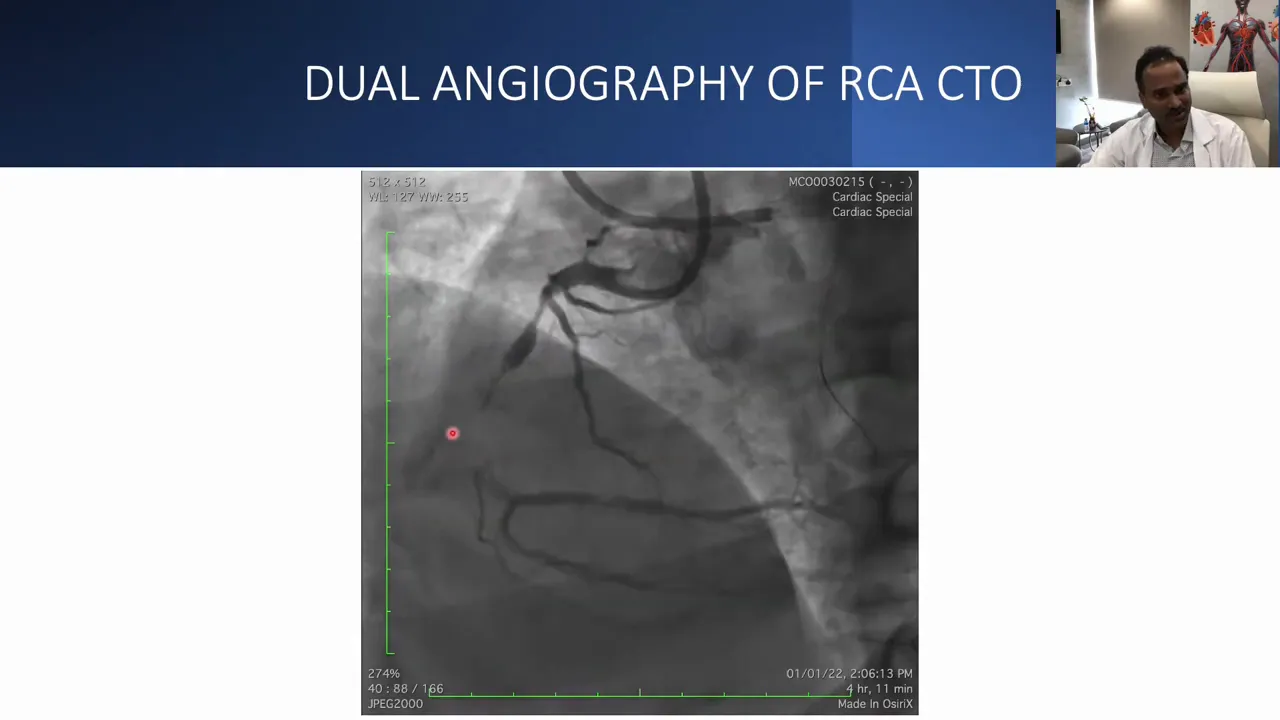 Clear dual-injection angiographic image of the right coronary artery showing both proximal and distal segments and collateral flow.