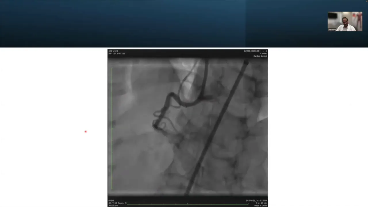 Final angiographic result post-stenting